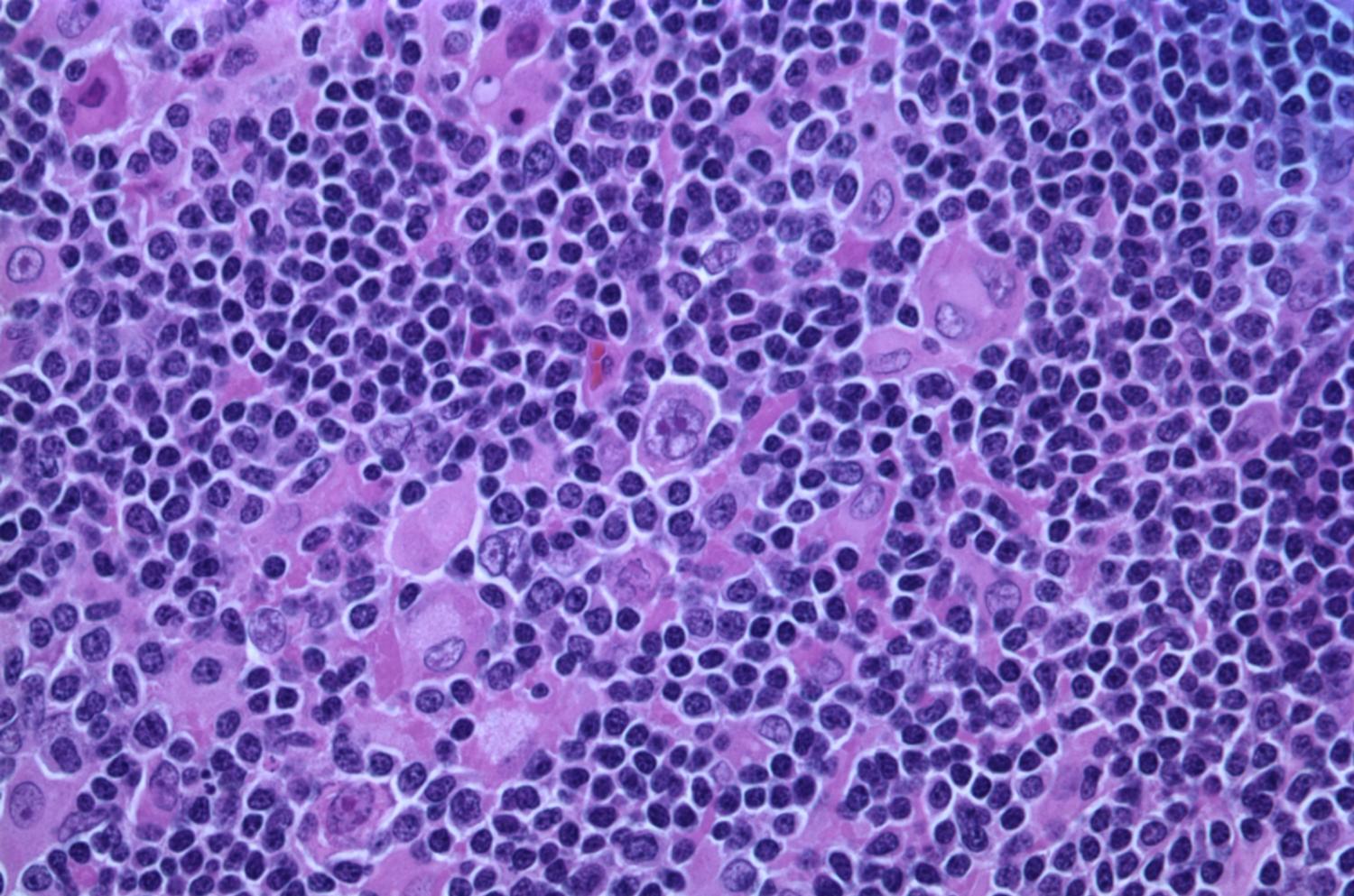 lymphoma immune aging