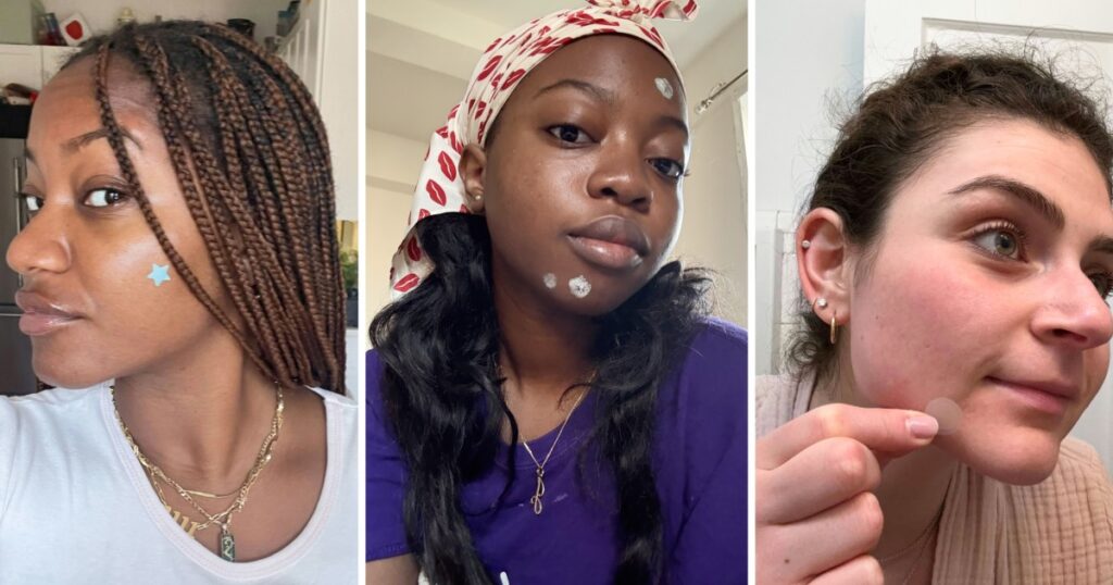 acne spot treatments