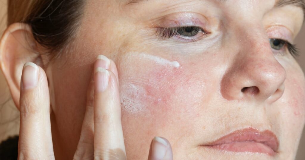 rosacea treatment