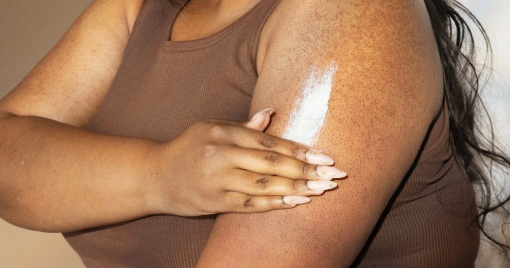 keratosis pilaris treatments