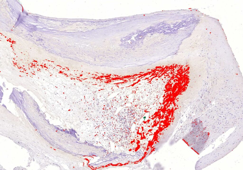 biofilm bacteria heart attacks
