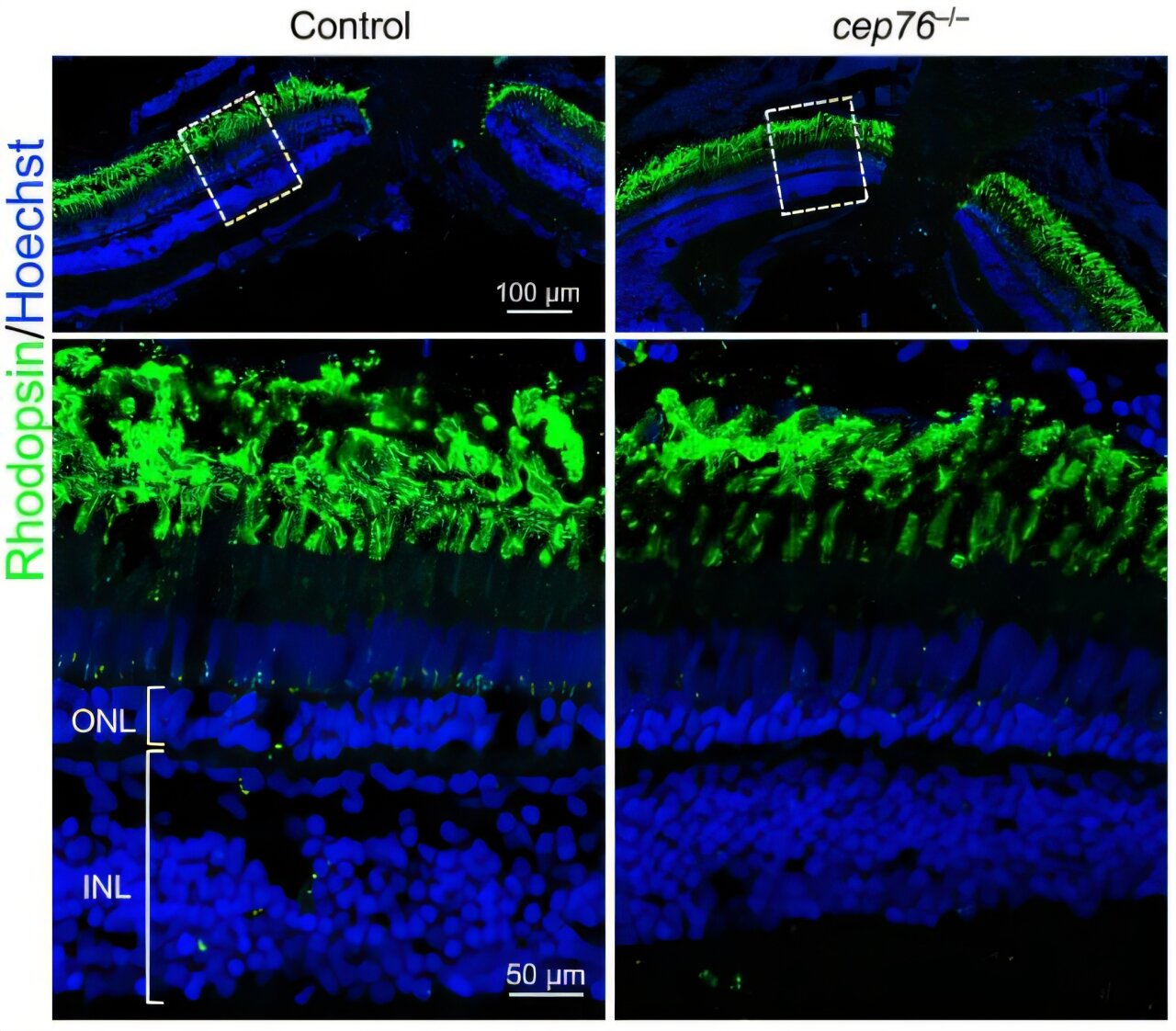 CEP76 ciliopathy