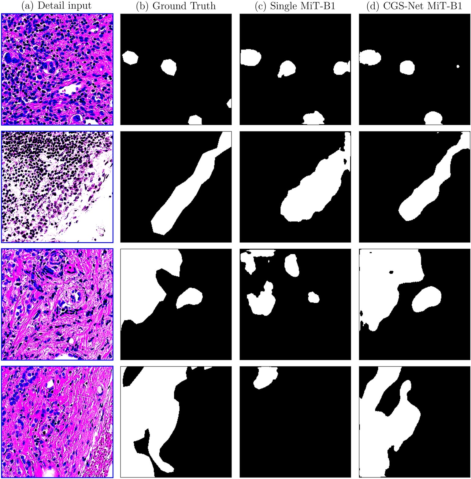 AI breast cancer analysis