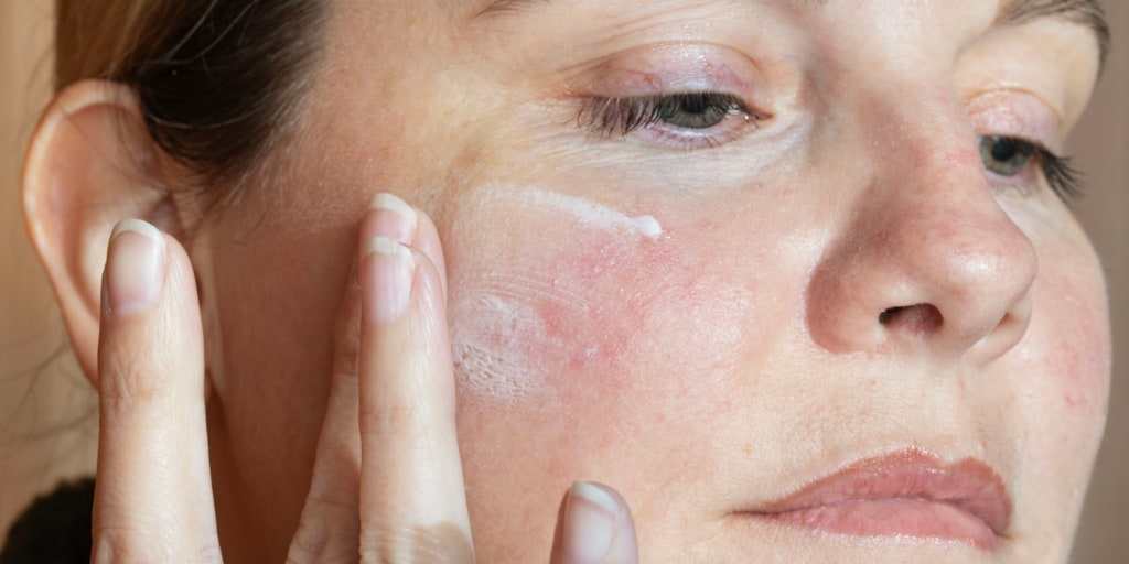 rosacea treatment