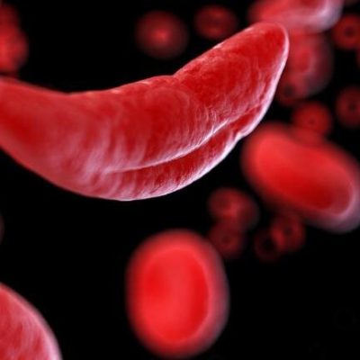 gene therapy sickle cell