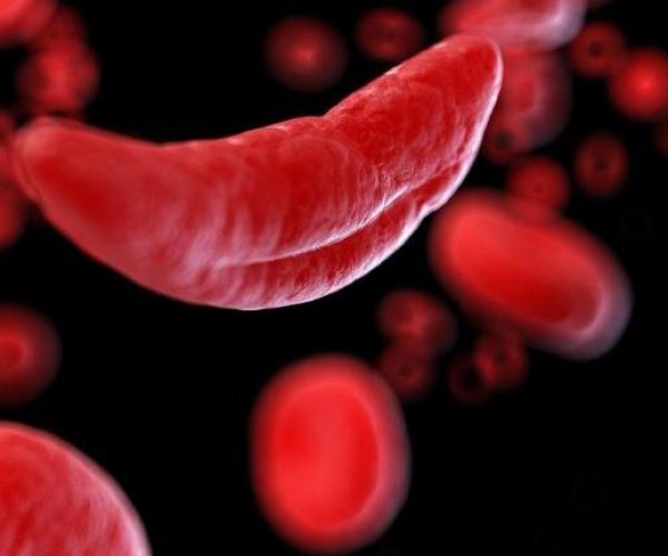 gene therapy sickle cell