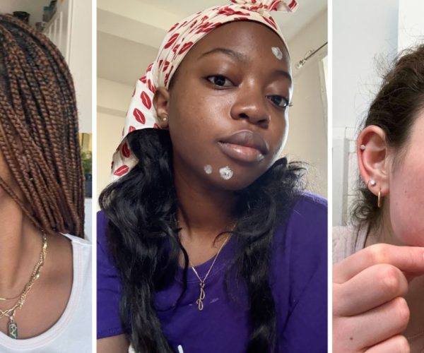 acne spot treatments