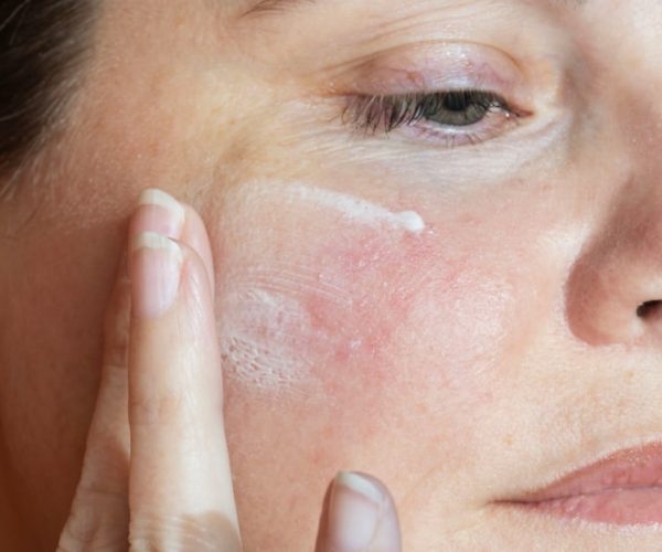 rosacea treatment