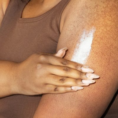 keratosis pilaris treatments