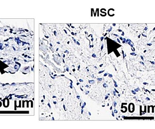 stem cells kidney dialysis