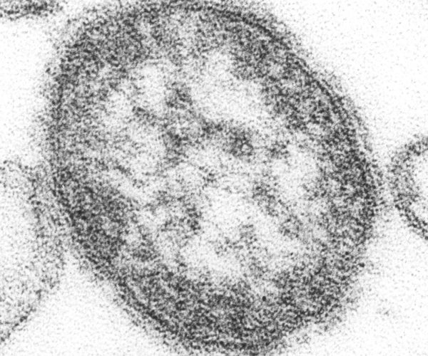 measles epidemic Canada