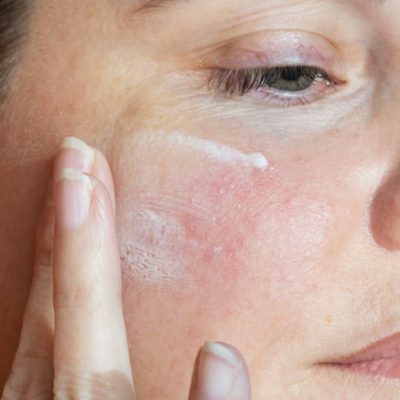 rosacea treatment