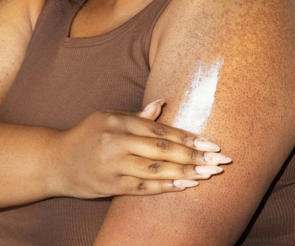 keratosis pilaris treatments