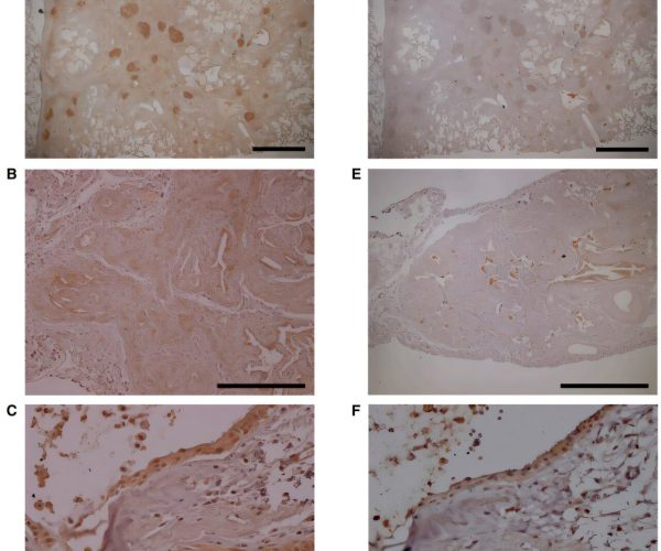 lung scarring risk