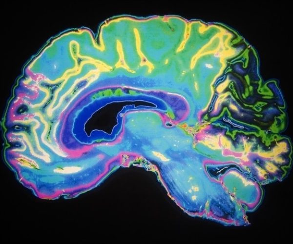 brainstem damage Covid-19