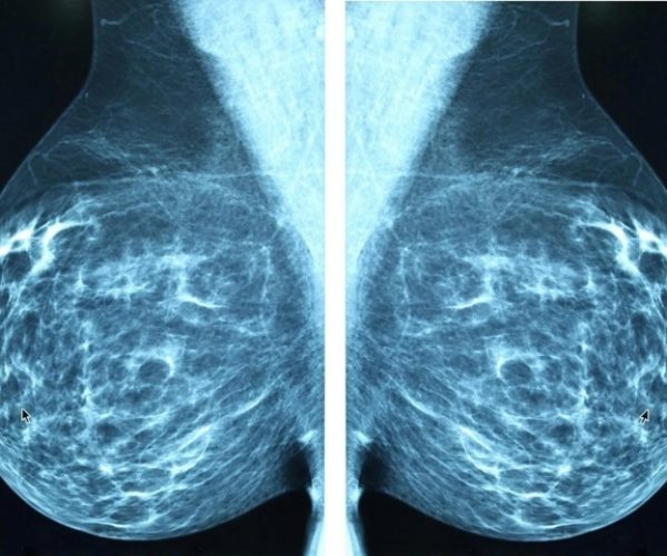 breast cancer younger adults