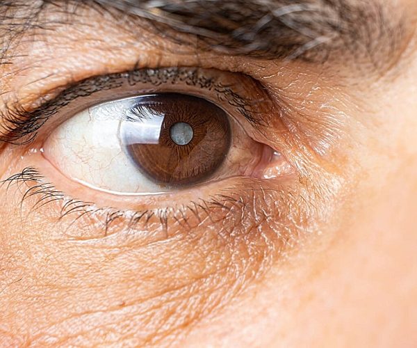 cataract surgery