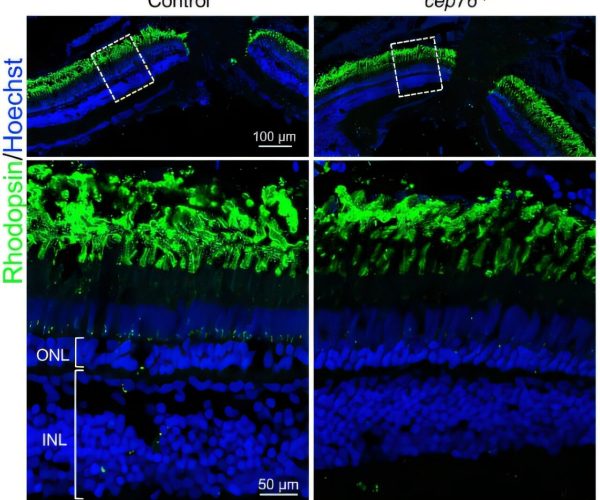 CEP76 ciliopathy