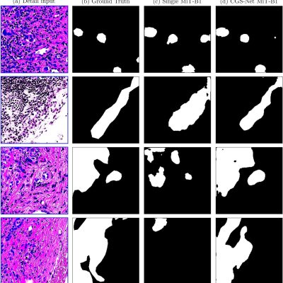 AI breast cancer analysis