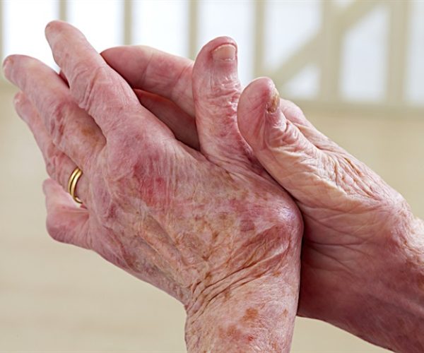 prebiotic fiber osteoarthritis